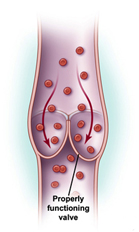 Chronic Venous Insufficiency Treatment offers info on Venous Insufficiency India, Chronic Venous Insufficiency India