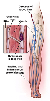 Chronic Venous Insufficiency India, Venous Disease India, CVI India