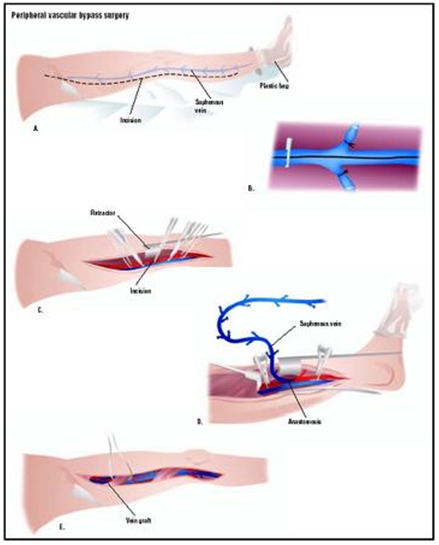 Peripheral Bypass Surgery offers info on Peripheral Bypass Surgery India, Peripheral Bypass India