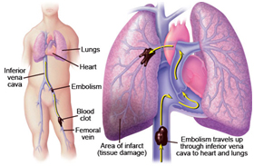 Pulmonary Endarterectomy Surgery offers info on Pulmonary Endarterectomy India