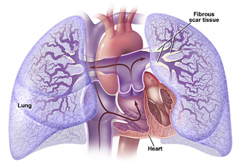 Pulmonary Endarterectomy Surgery offers info on Pulmonary Endarterectomy India, Outcomes Of Pulmonary Endarterectomy India