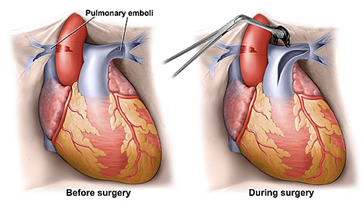 Outcomes Of Pulmonary Endarterectomy India, Outcomes India