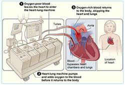 heart surgery in india cost