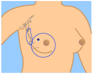 Breast Cancer India, Breast Cancer Treatment India, Breast India, Cancer India, Treatment India