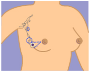 Breast India, Cancer India, Treatment India, Breast Cancer Information India