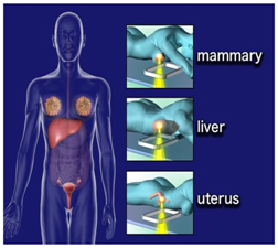 High Intensity Ultrasound Cost,High Intensity Focused Ultrasound India,Therapy Replace Conventional Surgery, High Intensity Focused Ultrasound Treatment, High Intensity, Hifu, High Intensity Focused Ultrasound, Hifu Specialist, Hifu Prostate Cancer, Miami Hifu, Hifu Treatment, High Intensity Focused Ultrasound Hospitals India, Noninvasive, Surgery, Cryotherapy, Cryocare