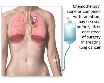 Lung Cancer Symptoms India, Lung Cancer Information India, Lung Cancer Charity India, Cancer India