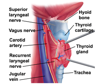 Laryngectomy Surgery, Laryngectomy, Laryngeal Surgery, Larynx, Laryngectomy Surgery India, Total Laryngectomy