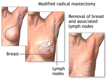 Mastectomy Surgery India offers info on Best Price Surgery Hospital India-Mastectomy India, Radical Mastectomy Surgery Delhi India