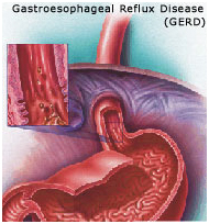 Reflux Surgery India, Reflux offers info on Reflux Surgery India, Reflux Disease India, GERD India, Symptoms Of Reflux Surgery India