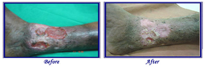 Varicose Ulcer Treatment offers info on Varicose Ulcer Surgery India