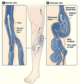 Varicose Vein Removal Surgery offers info on Varicose Vein Removal India, Vein Surgeon India, Varicose Vein India