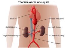 Aneurysm Repair Surgery, Aneurysm Surgery India