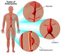 Aneurysm Repair Surgery, Vascular Surgeon, Thoracic Aneurysms