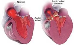 Aortic Valve Replacement Surgery, Aortic Valve Repair India