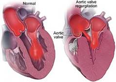 Aortic Valve Replacement Surgery, Valve Disease, Regurgitation, Problem, AVR