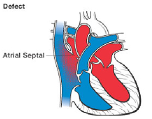  Atrial Septal Asd India, Atrial Septal Defect Surgery, Atrial Septal Defect
