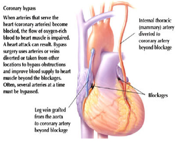 India CABG Surgery, Bypass Graft Surgery India Coronary Artery