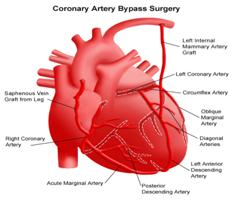 Coronary Artery Bypass Surgery, Bypass Graft Surgery India Coronary Artery, Heart Attack