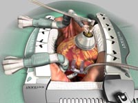 Coronary Artery Bypass Surgery, Bypass Graft Surgery India Coronary Artery, Heart Attack