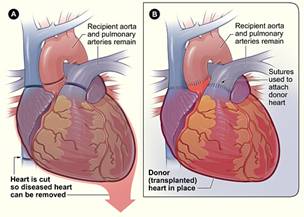 Heart Transplant Surgery, Support, Parents, Information
