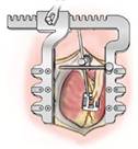 Minimally Invasive CABG Heart Surgery, India Hospital Tour, Minimally Invasive Coronary Artery Bypass Surgery