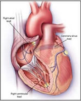 Pacemaker Temporary Implant, Pacemaker Implant India, Temporary External Pacemakers