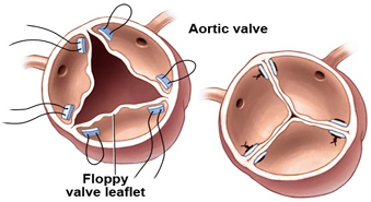 PAortic Valve Surgery India, Aortic Valve Disease, Stenosis, Regurgitation