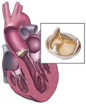 Pediatric Aortic Valve Replacement, Aortic Valve Surgery India, Aortic Valve Disease