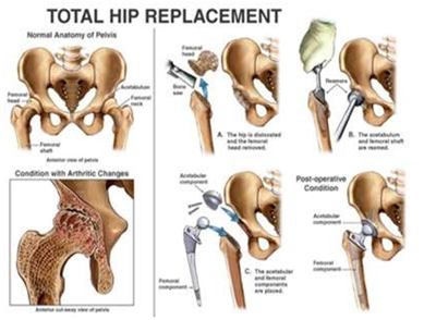 Cemented Total Hip Replacement, Cemented Total Hip Replacement in India, Cementless Hip Replacements
