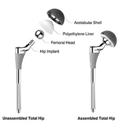 Hip Replacement Surgery India, Hip Replacement India, Hip Fracture Treatment