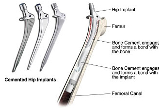 Hip Replacement Surgery India, Hip Replacement, Hip Arthroplasty, Hip Joint, Hip Fracture Treatment