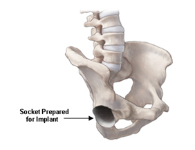 Hip Replacement India, Hip Replacement, Hip Joint, Prosthetic Implant, Hip Fracture Treatment