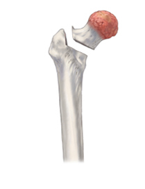 Hip Replacement, Hip Arthroplasty, Hip Joint, Prosthetic Implant, Hip Fracture Treatment