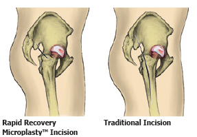 Minimally Invasive Hip Replacement Surgery, Minimally Invasive Hip Replacement Surgery India