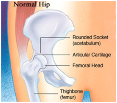Hip Surgery India, Virtual Surgery, Total Hip Replacement, Hip Replacement Surgery, Exercises