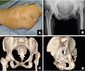 Uncemented Total Hip Replacement, Hip Replacements, Uncemented Total Hip Replacement India