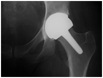 Birmingham Mid Head Resection Prosthesis (BMHR) India,Hip, Birmingham