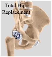 Minimally Invasive Hip Resurfacing Surgery, Minimally Invasive Hip Resurfacing Surgery India