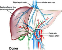 Liver Transplant Hospital India, Liver Transplant In India, Liver