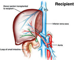 Liver Transplant In India, Liver, Liver Transplant, Primary Sclerosing Cholangitis