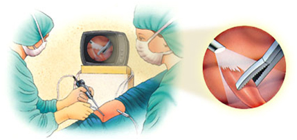 Arthroscopy Surgery, India Arthroscopic Surgery, Arthroscopic Procedure, Arthroscopy Surgery India