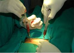 Liver Transplant Manipal Hospital India