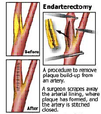 Carotid Endarterectomy Surgery India Offers info on Carotid Endarterectomy India, Carotid Artery Surgery India