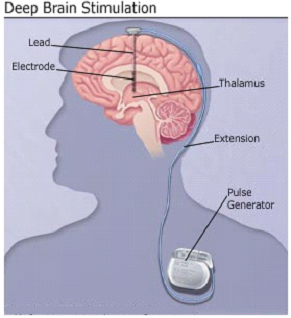 Deep Brain Stimulation Surgery India Offers info on Stimulation India, Stimulating India