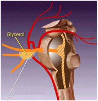 Glycerol Injection Surgery India Offers info on Glycerol Injection India, Glycerol India, Trigeminal Neuralgia India, Glycerol Injection Surgery India