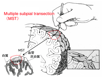 Multiple Subpial Transections Surgery India Offers info on MST India, Multiple Subpial Transection Epilepsy India