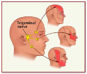 Trigeminal Neuralgia India Offers info on Trigeminal Neuralgia Treatment India, Trigeminal India, Neuralgia India