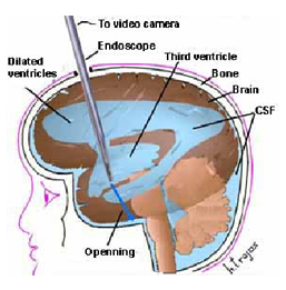 Ventriculostomy Surgery India Offers info on Ventriculostomy Surgery India, Ventriculostomy India