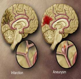 Cerebral Aneurysm Treatment India Offers info on Cerebral Aneurysm India, Brain Aneurysm India